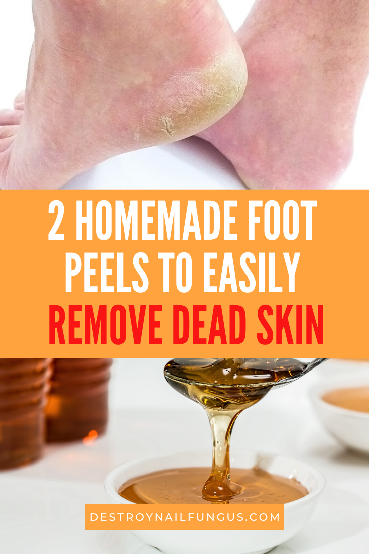 foot dead skin remover diy